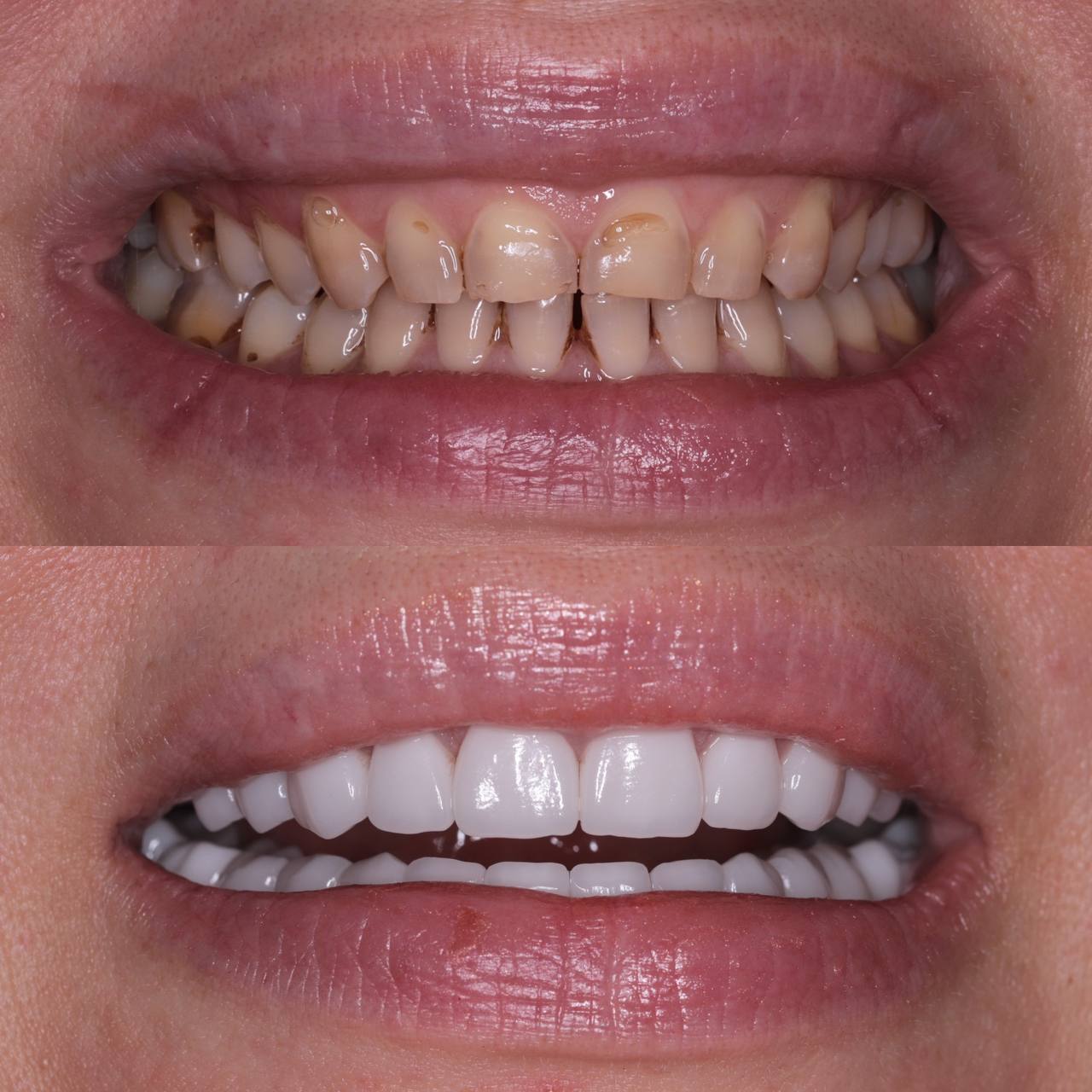 Hollywood Smile